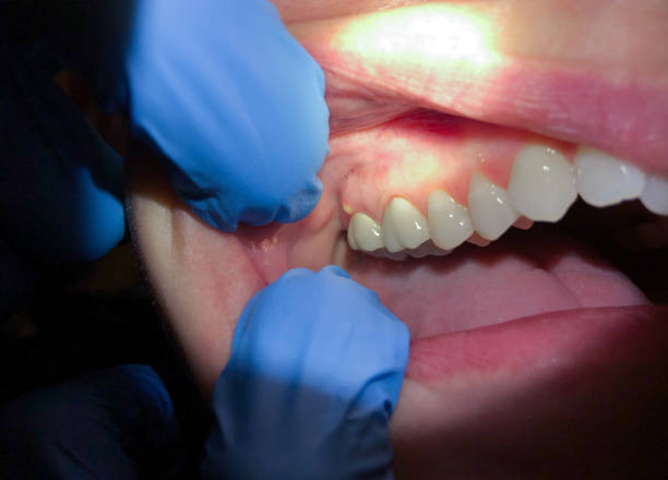 Best Chipped Tooth Repair Near Me  in Awendaw, SC